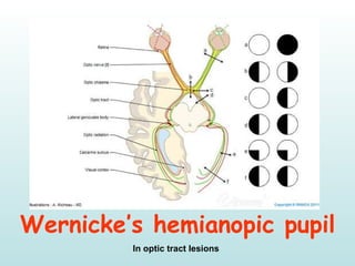 Wernicke’s hemianopic pupil
In optic tract lesions
 