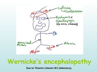 Wernicke’s encephalopathy
Due to Thiamin (vitamin B1) defeciency
 