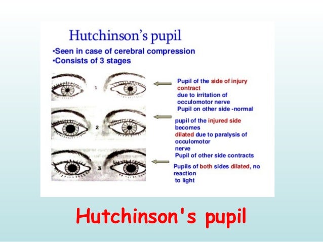 Ophthalmology Eponyms II