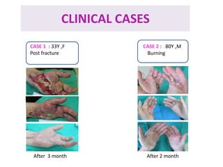 CLINICAL CASES
C
CASE 1 : 33Y ,F
Post fracture
CASE 2 : 80Y ,M
Burning
After 3 month After 2 month
 