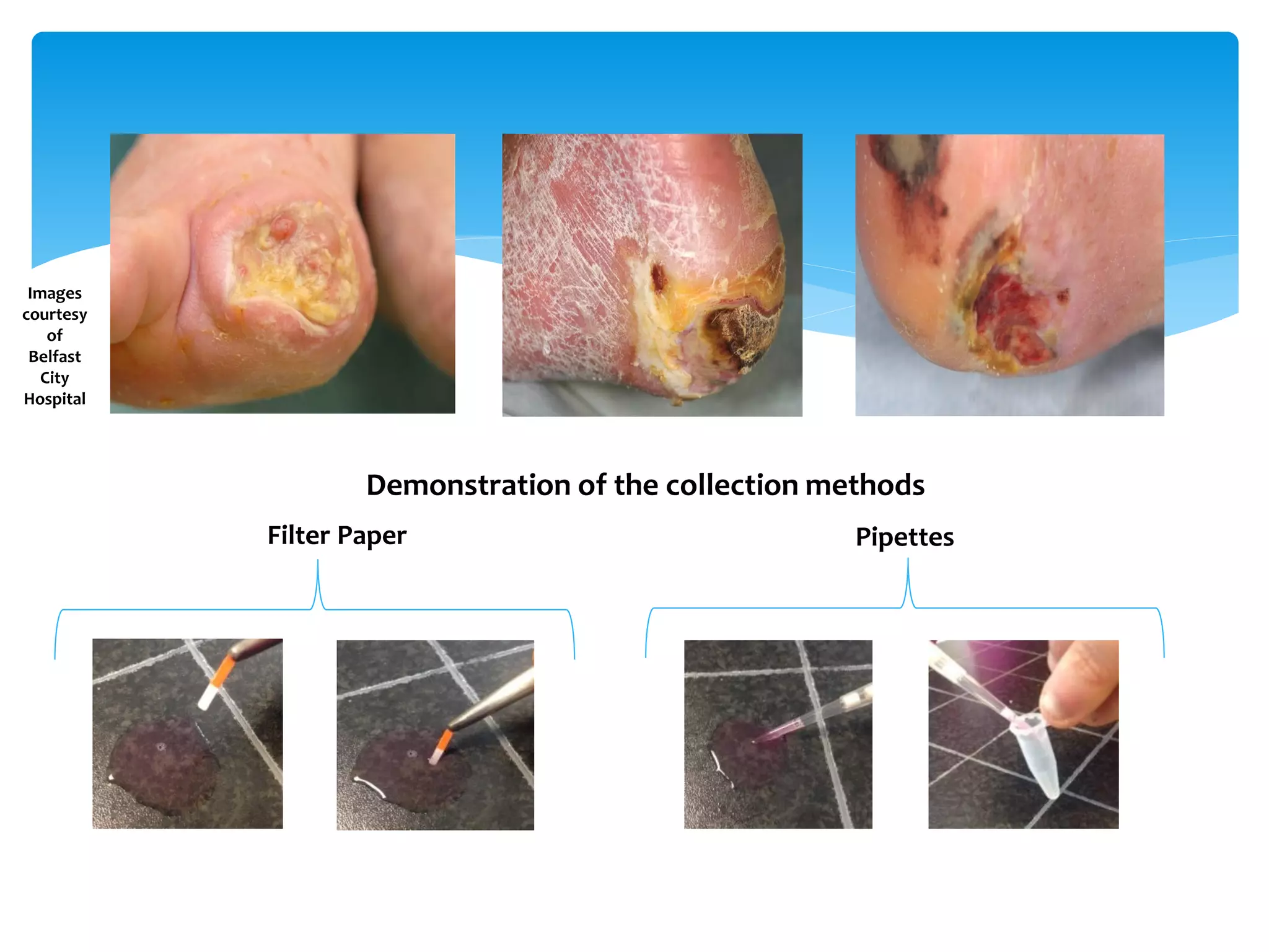 Demonstration of the collection methods
Filter Paper Pipettes
Images
courtesy
of
Belfast
City
Hospital
 