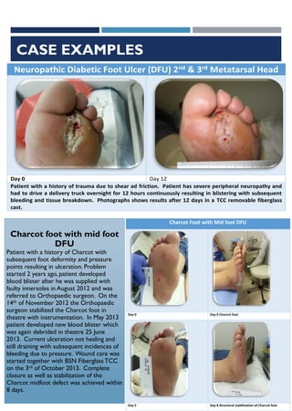 CASE EXAMPLES
Neuropathic Diabetic Foot Ulcer (DFU) 2nd & 3rd Metatarsal Head
Day 0 Day 12
Patient with a history of trauma due to shear ad friction. Patient has severe peripheral neuropathy and
had to drive a delivery truck overnight for 12 hours continuously resulting in blistering with subsequent
bleeding and tissue breakdown. Photographs shows results after 12 days in a TCC removable fiberglass
cast.
EWMA 2014 EP495
3
Charcot Foot with Mid foot DFU
Day 0 Day 0 Charcot foot
Day 5 Day 8 Structural stabilisation of Charcot foot
Charcot foot with mid foot
DFU
Patient with a history of Charcot with
subsequent foot deformity and pressure
points resulting in ulceration. Problem
started 2 years ago, patient developed
blood blister after he was supplied with
faulty innersoles in August 2012 and was
referred to Orthopaedic surgeon. On the
14th of November 2012 the Orthopaedic
surgeon stabilized the Charcot foot in
theatre with instrumentation. In May 2013
patient developed new blood blister which
was again debrided in theatre 25 June
2013. Current ulceration not healing and
still draining with subsequent incidences of
bleeding due to pressure. Wound care was
started together with BSN Fiberglass TCC
on the 3rd of October 2013. Complete
closure as well as stabilization of the
Charcot midfoot defect was achieved within
8 days.
 