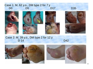 4
Case 1: M, 62 y.o., DM type 2 for 7 y
D0 D5 D17 D35
Case 2: M, 39 y.o., DM type 2 for 12 y
D 14 D42
 