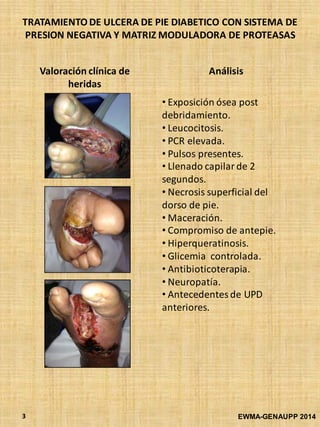 TRATAMIENTO DE ULCERA DE PIE DIABETICO CON SISTEMA DE
PRESION NEGATIVA Y MATRIZ MODULADORA DE PROTEASAS
EWMA-GENAUPP 20143
Valoración clínica de
heridas
Análisis
• Exposición ósea post
debridamiento.
• Leucocitosis.
• PCR elevada.
• Pulsos presentes.
• Llenado capilar de 2
segundos.
• Necrosis superficial del
dorso de pie.
• Maceración.
• Compromiso de antepie.
• Hiperqueratinosis.
• Glicemia controlada.
• Antibioticoterapia.
• Neuropatía.
• Antecedentes de UPD
anteriores.
 