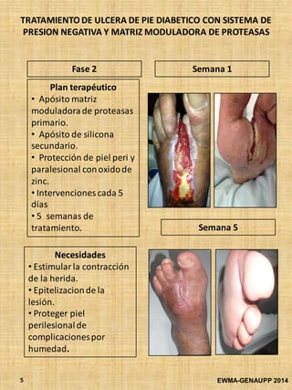 TRATAMIENTO DE ULCERA DE PIE DIABETICO CON SISTEMA DE
PRESION NEGATIVA Y MATRIZ MODULADORA DE PROTEASAS
EWMA-GENAUPP 20145
Plan terapéutico
• Apósito matriz
moduladorade proteasas
primario.
• Apósito de silicona
secundario.
• Protección de piel peri y
paralesional conoxidode
zinc.
• Intervenciones cada 5
días
• 5 semanas de
tratamiento.
Necesidades
• Estimularla contracción
de la herida.
• Epitelizacionde la
lesión.
• Proteger piel
perilesionalde
complicacionespor
humedad.
Semana 1
Semana 5
Fase 2
 