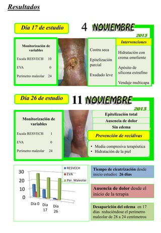 4
11
Día 17 de estudio
Resultados
Monitorización de
variables
Escala RESVECH 10
EVA 0
Perímetro maleolar 24
Costra seca
Epitelización
parcial
Exudado leve
Hidratación con
crema emoliente
Apósito de
silicona extrafino
Vendaje multicapa
Día 26 de estudio
Monitorización de
variables
Escala RESVECH 1
EVA 0
Perímetro maleolar 24
Ausencia de dolor
Epitelización total
Sin edema
Intervenciones
• Media compresiva terapéutica
• Hidratación de la piel
Prevención de recidivas
0
10
20
30
Día 0 Día
17
Día
26
RESVECH
EVA
Per. Maleolar
Tiempo de cicatrización desde
inicio estudio: 26 días
Ausencia de dolor desde el
inicio de la terapia
Desaparición del edema en 17
días reduciéndose el perímetro
maleolar de 28 a 24 centímetros
 