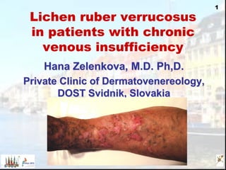 1
Lichen ruber verrucosus
in patients with chronic
venous insufficiency
Hana Zelenkova, M.D. Ph,D.
Private Clinic of Dermatovenereology,
DOST Svidnik, Slovakia
 