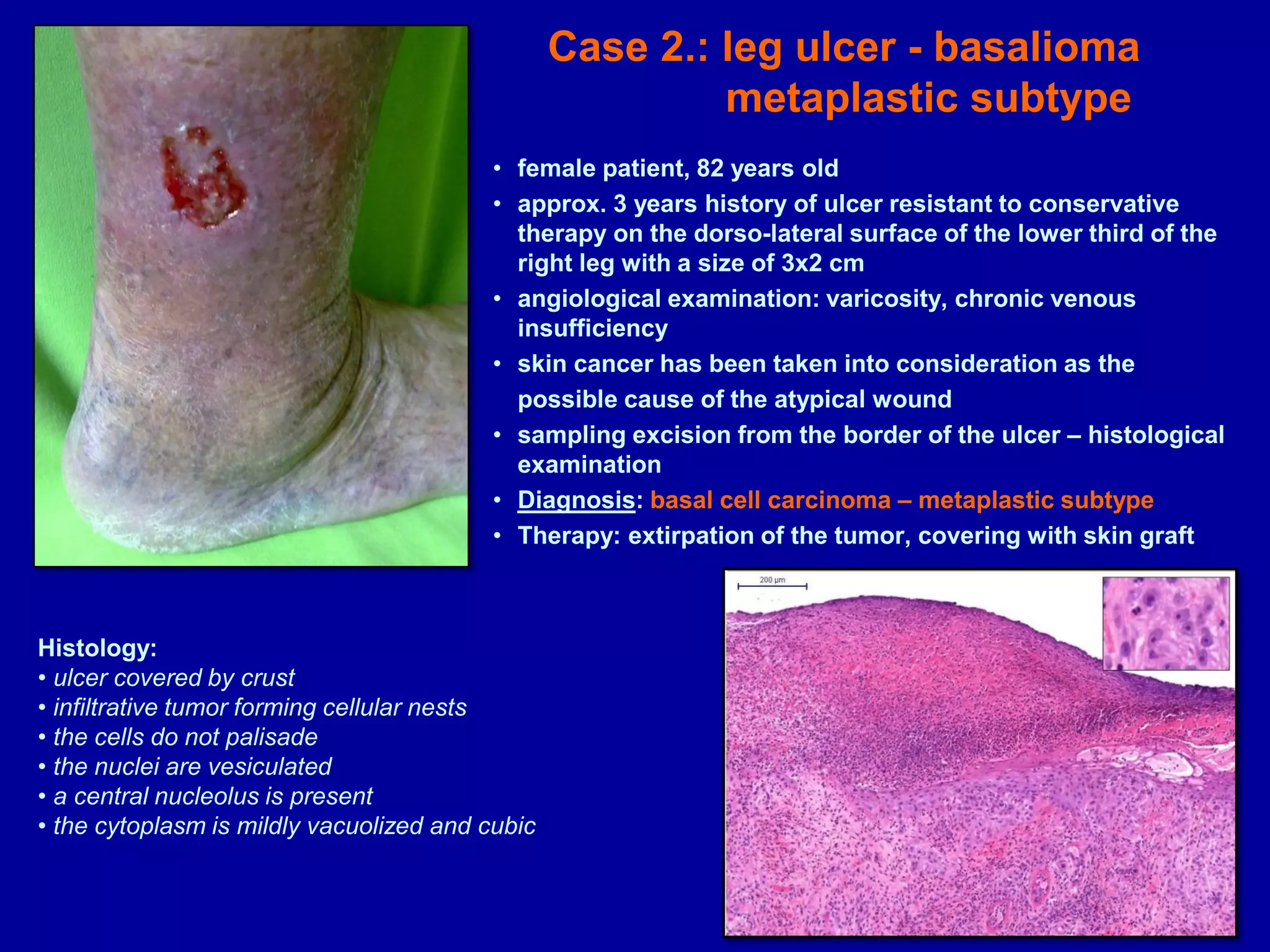 EWMA 2013 - Ep519 - DIFFERENTIAL DIAGNOSIS OF LEG ULCERS - ULCERS OF ...