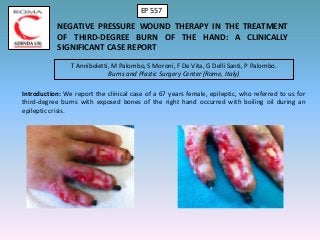 NEGATIVE PRESSURE WOUND THERAPY IN THE TREATMENT
OF THIRD-DEGREE BURN OF THE HAND: A CLINICALLY
SIGNIFICANT CASE REPORT
T Anniboletti, M Palombo, S Moroni, F De Vita, G Delli Santi, P Palombo.
Burns and Plastic Surgery Center (Rome, Italy)
Introduction: We report the clinical case of a 67 years female, epileptic, who referred to us for
third-degree burns with exposed bones of the right hand occurred with boiling oil during an
epileptic crisis.
EP 557
 