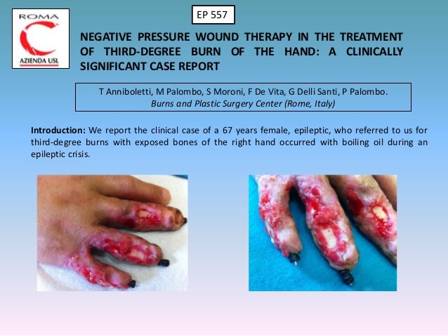 3rd Degree Burn Treatment 3rd Degree Burn Treatment