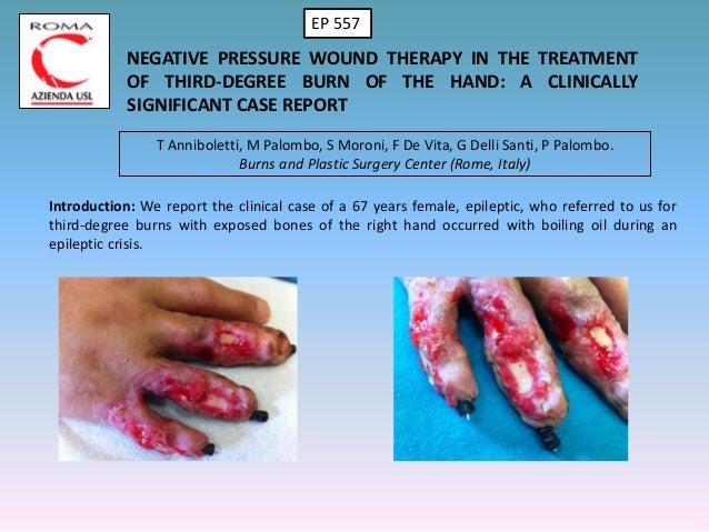 EWMA 2013 - Ep557 - NEGATIVE PRESSURE WOUND THERAPY IN THE ...