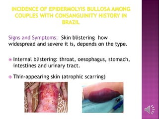 Signs and Symptoms: Skin blistering how
widespread and severe it is, depends on the type.
 Internal blistering: throat, oesophagus, stomach,
intestines and urinary tract.
 Thin-appearing skin (atrophic scarring)‫‏‬
 
