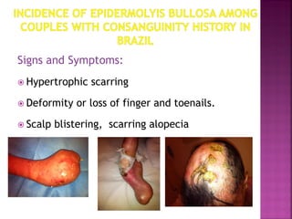 Signs and Symptoms:
 Hypertrophic scarring
 Deformity or loss of finger and toenails.
 Scalp blistering, scarring alopecia
 