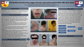 Consecutive reconstructive surgery of trunk, neck and face deformities after burn injury
MD E. Zacharevskij1 , MD PhD V. Kaikaris1, MD PhD R. Rimdeika1, G. Samulėnas2
1Department of Plastic and Reconstructive Surgery, Hospital of Lithuanian University of Health Sciences
2Faculty of Medicine, Medical Academy, Lithuanian University of Health Sciences
Introduction
A 25 year old man at the age of fifteen was injured in a fire
accident and underwent long hospital stay and several skin
transfer operations. During the post injury period he suffered
from residual skin contractures, located in the left armpit
region, neck, face and microoris.
Reconstructive operations schedule was composed for the
patient considering main complains and major post burn
contractures.
•Firstly, scar excision and skin flap rotation was performed in
the left armpit region in order to increase left hand
elevation.
•Next procedure was a combined microoris correction with
infranasal region plasty and expander insertion.
•After three months of expanding there was sufficient skin to
cover right neck region after eliminating the neck
contracture. In post-operative period patient underwent
physiotherapy and scar reducing procedures.
Discussion
Burn survivors face a variety of chalenges, including
physical, psychological and social aspects. The generic
health status (SF-36 questionare) of a burn patient is
significantly lower than general population scores.1 The
Health Related Quality of Life (HRQoL) scores are worse
in comparison with general population (respectively
0,839 ± 0,125 and 0,936 ± 0,071),and do not improve
significantly during 2-year follow up2. Consecutive
surgical approach could modify physical aspects and
decrease dissatisfaction of body appearance, thus
lowering chances of depression.
We report a case of a successful multi-stage reconstruction of
a burn injury, which included body areas of high importance
concerning psychological and physical aspects.
Case presentation
Results, conclusions
After two years of treatment patient has proper left hand
elevation, neck rotation and microoris correction. Patients after
deep skin burns need permanent supervision and an incentive
to start treatment3. Well planed consecutive reconstructive
surgery significantly improves life quality of burned patients.
References
1.Moi, A.L., Wentzel-Larsen, T., Salemark, L., Wahl, A.K., Hanestad, B.R. Impaired generic
health status but perception of good quality of life in survivors of burn injury. Journal of
Trauma - Injury, Infection and Critical Care, Volume 61, Issue 4, October 2006, Pages 961-
968
2.Koljonen V, Laitila M, Sintonen H, Roine RP. Health-related quality of life of hospitalized
patients with burns-comparison with general population and a 2-year follow-up.
Burns. 2013 May;39(3):451-7
3.Rea SM, Goodwin-Walters A, Wood FM. Surgeons and scars: differences between
patients and surgeons in the perceived requirement for reconstructive surgery following
burn injury. Burns. 2006 May;32(3):276-83
Depression
Physical function
Age
Body image
dissatisfaction
TBSA (%) burned
Facial burn
Female sex
Before operation
Expander insertion and filling stages
 