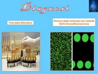 Ricerca degli anticorpi con metodo
Test della Bilirubina       Dell’immunofluorescenza
 