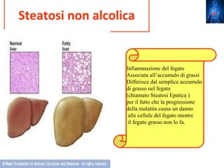 Steatosi non alcolica


                   Infiammazione del fegato
                   Associata all’accumulo di grassi
                   Differisce dal semplice accumulo
                   di grasso nel fegato
                   (chiamato Steatosi Epatica )
                   per il fatto che la progressione
                   della malattia causa un danno
                    alle cellule del fegato mentre
                    il fegato grasso non lo fa.
 