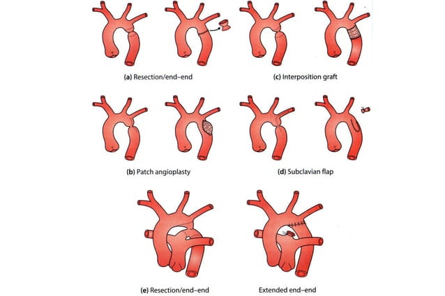 coarcta-o-da-aorta-arco-a-rtico-interrompido-e-estenose-pulmonar-ppt