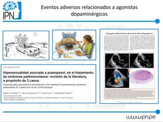 Eventos adversos relacionados a agonistas
dopaminérgicos
 