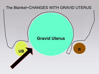 1616
UB
Gravid Uterus
R
The Blanket~CHANGES WITH GRAVID UTERUS
 