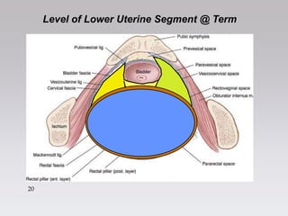 2
0
20
Level of Lower Uterine Segment @ Term
 