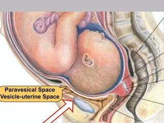 2
1
21
Paravesical Space
Vesicle-uterine Space
 