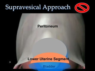 Supravesical Approach
26
Peritoneum
Bladder
Bladder
Lower Uterine Segment
 