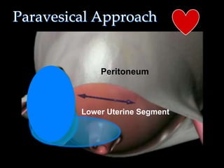 Paravesical Approach
27
Peritoneum
Lower Uterine Segment
 