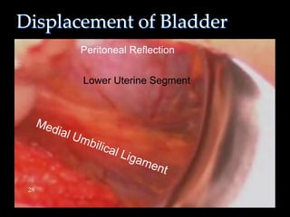 Displacement of Bladder
28
Lower Uterine Segment
Peritoneal Reflection
 