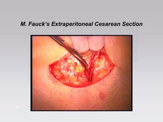 4444
M. Fauck’s Extraperitoneal Cesarean Section
 