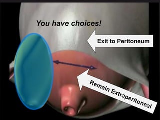 5050
Exit to Peritoneum
You have choices!
 