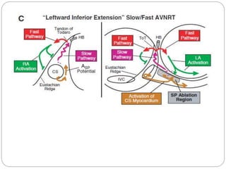 Ep diagnosis and ablation of avnrt | PPTX