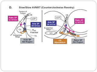 Ep diagnosis and ablation of avnrt | PPTX
