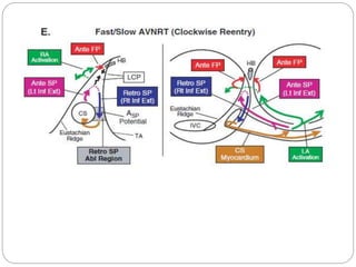 Ep diagnosis and ablation of avnrt | PPTX