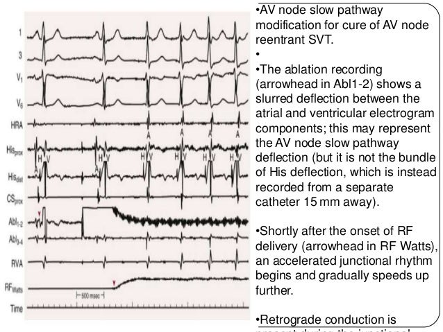 What Is Avnrt Ablation _ Atrioventricular nodal reentry tachycardia ...