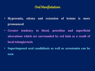 • Hyperemia, edema and extension of lesions is more
pronounced
• Greater tendency to bleed, petechiae and superficial
ulcerations which are surrounded by red halo as a result of
local telangiectasis
• Superimposed oral candidiasis as well as xerostomia can be
seen
Oral Manifestations
 