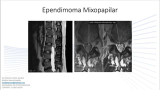 Ependimoma Mixopapilar
 