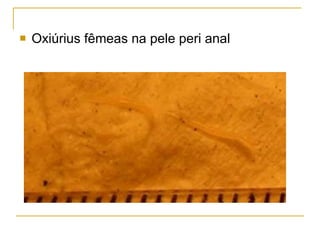Oxiúrius fêmeas na pele peri anal 