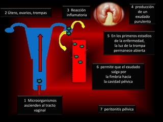 4  producción de un exudado purulento 3  Reacción inflamatoria  2 Útero, ovarios, trompas5  En los primeros estadios de la enfermedad, la luz de la trompa permanece abierta 6  permite que el exudadosalga porla fimbria hacia la cavidad pélvica 1  Microorganismos ascienden al tracto vaginal7  peritonitis pélvica