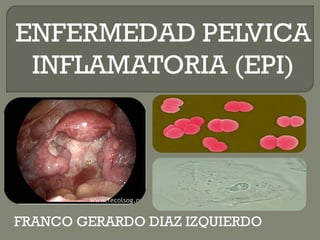 ENFERMEDAD PELVICA
 INFLAMATORIA (EPI)




FRANCO GERARDO DIAZ IZQUIERDO
 