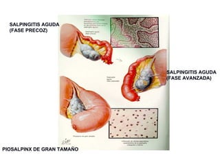 SALPINGITIS AGUDA (FASE PRECOZ) SALPINGITIS AGUDA  (FASE AVANZADA) PIOSALPINX DE GRAN TAMAÑO Enfermedad Pélvica Inflamatoria 