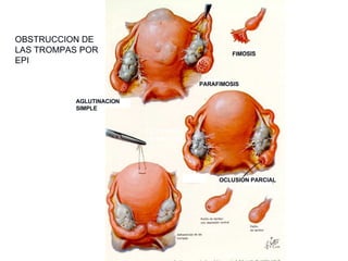 OBSTRUCCION DE LAS TROMPAS POR EPI OCLUSION COMPLETA FIMOSIS PARAFIMOSIS OCLUSION PARCIAL AGLUTINACION SIMPLE Enfermedad Pélvica Inflamatoria 