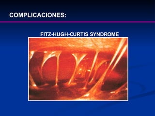 COMPLICACIONES: FITZ-HUGH-CURTIS SYNDROME 