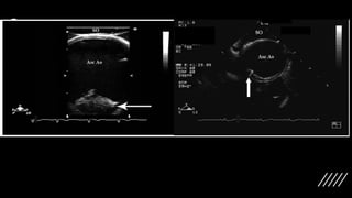 Aortic atherosclerosis and epiaortic scanning | PPTX