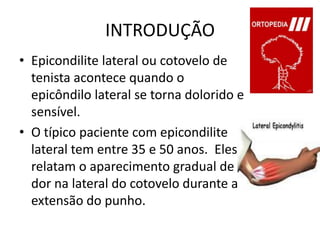 INTRODUÇÃOEpicondilite lateral ou cotovelo de tenista acontece quando o epicôndilo lateral se torna dolorido e sensível.O típico paciente com epicondilite lateral tem entre 35 e 50 anos.  Eles relatam o aparecimento gradual de dor na lateral do cotovelo durante a extensão do punho.