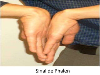 Sinal de Phalen