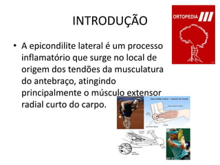 INTRODUÇÃOA epicondilite lateral é um processo inflamatório que surge no local de origem dos tendões da musculatura do antebraço, atingindo principalmente o músculo extensor radial curto do carpo.