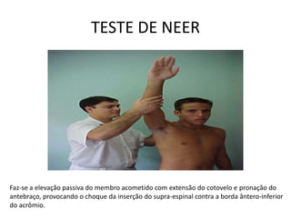 TESTE DE NEERFaz-se a elevação passiva do membro acometido com extensão do cotovelo e pronação do antebraço, provocando o choque da inserção do supra-espinal contra a borda ântero-inferior do acrômio.