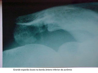 Grande esporão ósseo na borda ântero-inferior do acrômio