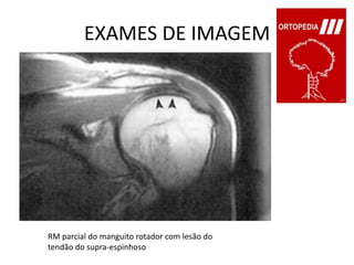 EXAMES DE IMAGEMRM parcial do manguito rotador com lesão dotendão do supra-espinhoso