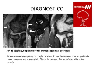 DIAGNÓSTICORM do cotovelo, no plano coronal, em três sequências diferentes.Espessamento heterogêneo da porção proximal do tendão extensor comum, podendo haver pequenas rupturas parciais. Edema de partes moles superficiais adjacentes (setas).